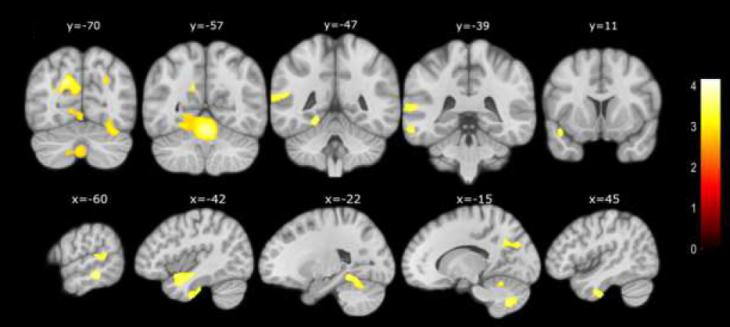 Cambios cerebrales en personas con declive cognitivo subjetivo