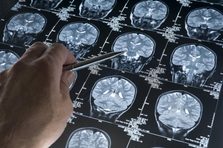 La comunidad científica adopta una nueva definición para la investigación del Alzheimer basada en biomarcadores