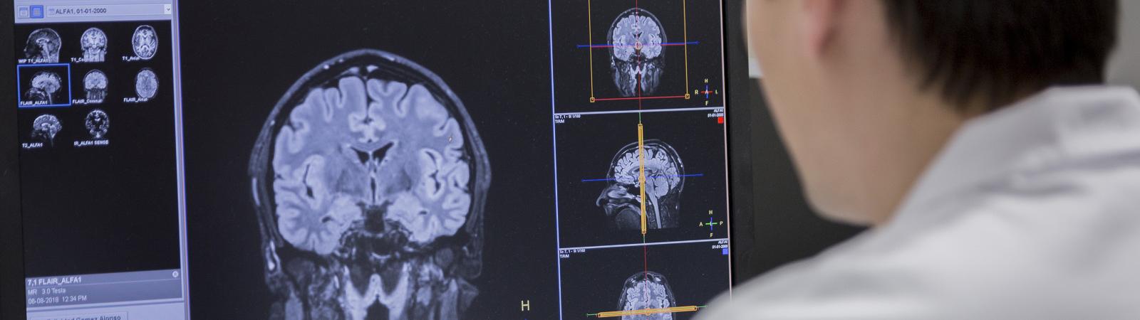 Investigació pionera en prevenció de la malaltia d’Alzheimer